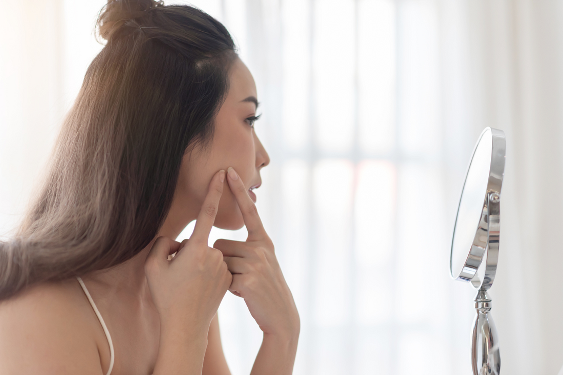 Can Skincare Products Prevent or Cause Acne?